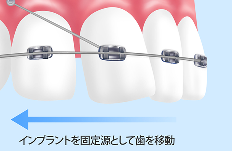 インプラント矯正